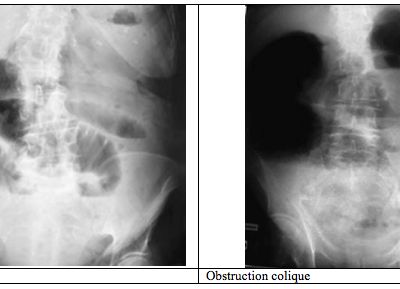 Occlusion intestinale